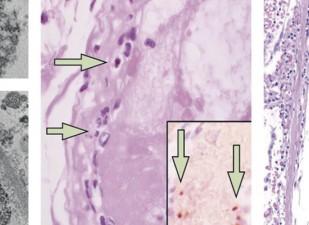 Infección de células endoteliales y endotelitis en COVID-19